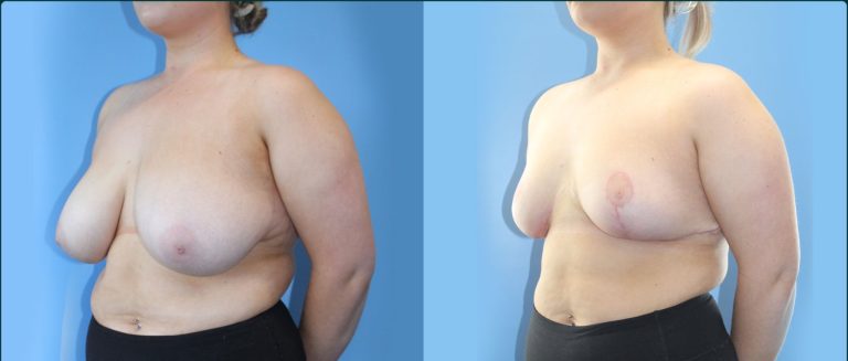 Breast reduction before and after, 45° left view, female patient, case BRR-L20, Dr Rohit Kumar, Sydney