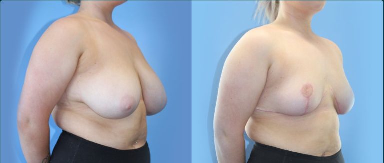 Breast reduction before and after, 45° right view, female patient, case BRR-L20, Dr Rohit Kumar, Sydney