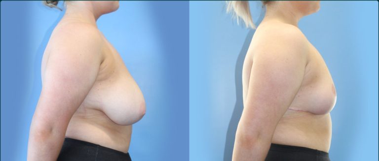 Breast reduction before and after, 90° right view, female patient, case BRR-L20, Dr Rohit Kumar, Sydney