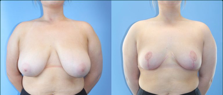 Breast reduction before and after, front view, female patient, case BRR-L20, Dr Rohit Kumar, Sydney