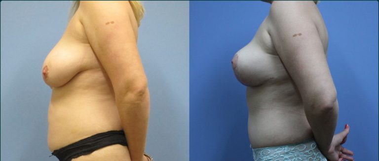 Breast reduction before and after, 90° left view, female patient, case BRR-L21, Dr Rohit Kumar, Sydney