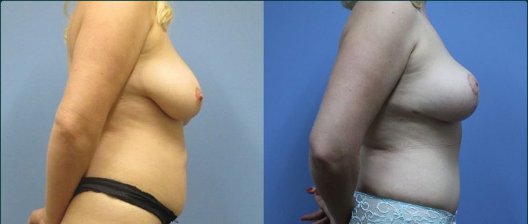Breast reduction before and after, 90° right view, female patient, case BRR-L21, Dr Rohit Kumar, Sydney