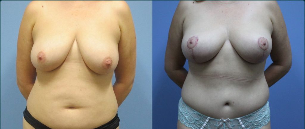 Breast reduction before and after, front view, female patient, case BRR-L21, Dr Rohit Kumar, Sydney
