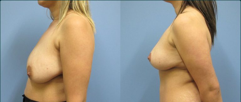 Breast reduction before and after, 90° left view, female patient, case BRR-L22, Dr Rohit Kumar, Sydney