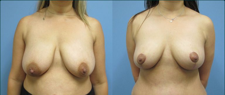 Breast reduction before and after, front view, female patient, case BRR-L22, Dr Rohit Kumar, Sydney