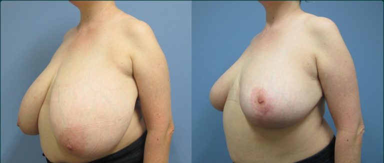 Breast reduction before and after, 45° left view, female patient, case BRR-L23, Dr Rohit Kumar, Sydney