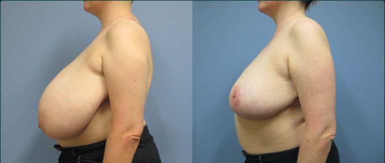 Breast reduction before and after, 90° left view, female patient, case BRR-L23, Dr Rohit Kumar, Sydney