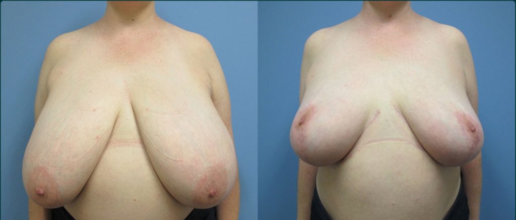 Breast reduction before and after, front view, female patient, case BRR-L23, Dr Rohit Kumar, Sydney