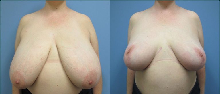 Breast reduction before and after, front view, female patient, case BRR-L23, Dr Rohit Kumar, Sydney