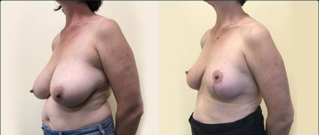 Breast reduction before and after, 45° left view, female patient, case BRR-L24, Dr Rohit Kumar, Sydney
