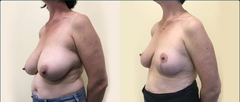 Breast reduction before and after, 45° left view, female patient, case BRR-L24, Dr Rohit Kumar, Sydney
