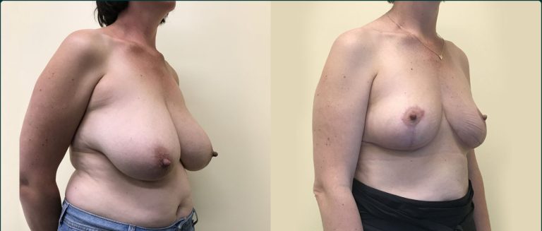 Breast reduction before and after, 45° right view, female patient, case BRR-L24, Dr Rohit Kumar, Sydney