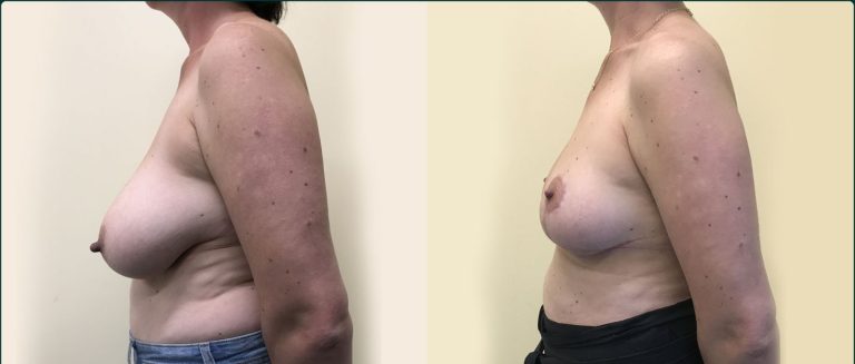 Breast reduction before and after, 90° left view, female patient, case BRR-L24, Dr Rohit Kumar, Sydney