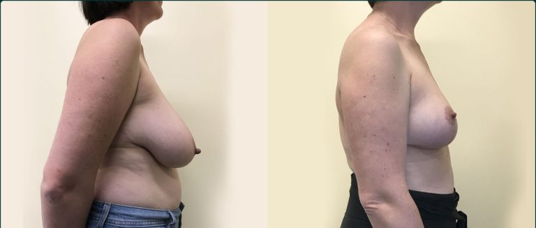Breast reduction before and after, 90° right view, female patient, case BRR-L24, Dr Rohit Kumar, Sydney