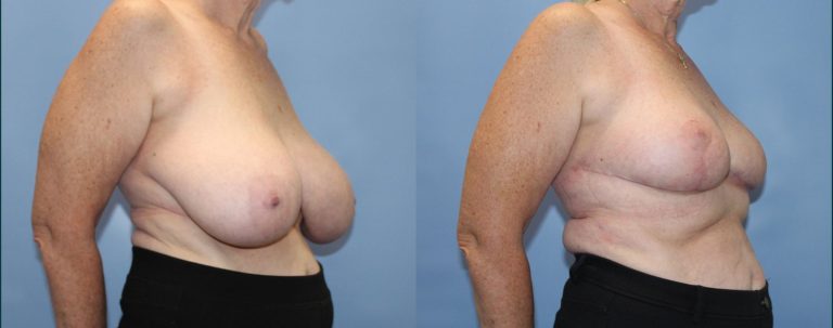 Breast reduction before and after, 45° right view, female patient, case BRR-L25, Dr Rohit Kumar, Sydney