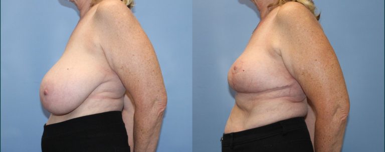 Breast reduction before and after, 90° left view, female patient, case BRR-L25, Dr Rohit Kumar, Sydney