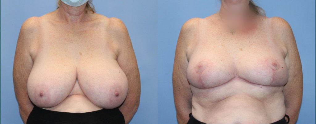 Breast reduction before and after, front view, female patient, case BRR-L25, Dr Rohit Kumar, Sydney