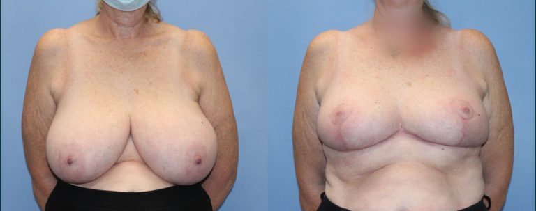 Breast reduction before and after, front view, female patient, case BRR-L25, Dr Rohit Kumar, Sydney