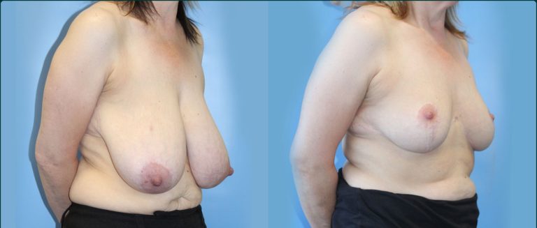 Breast reduction before and after, 45° right view, female patient, case BRR-L26, Dr Rohit Kumar, Sydney