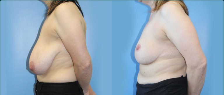 Breast reduction before and after, 90° left view, female patient, case BRR-L26, Dr Rohit Kumar, Sydney