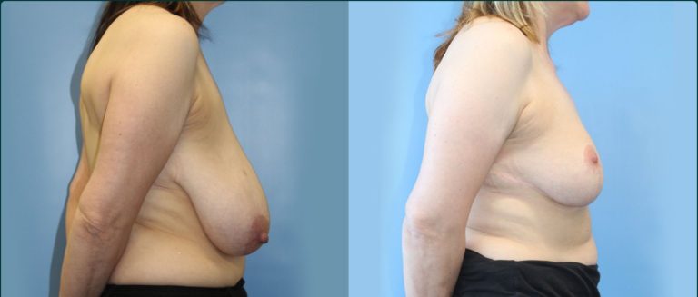 Breast reduction before and after, 90° right view, female patient, case BRR-L26, Dr Rohit Kumar, Sydney