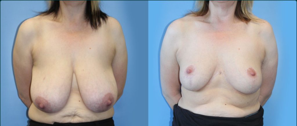 Breast reduction before and after, front view, female patient, case BRR-L26, Dr Rohit Kumar, Sydney