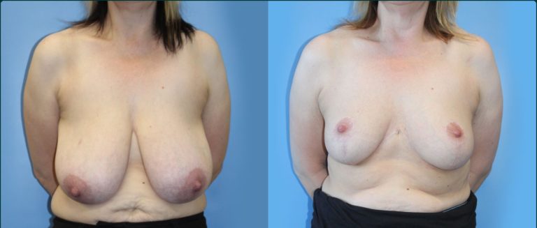 Breast reduction before and after, front view, female patient, case BRR-L26, Dr Rohit Kumar, Sydney