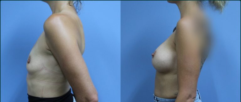 Fat grafting (fat transfer) before and after, 90° left view, female patient, case FAT-L01, Dr Rohit Kumar, Sydney