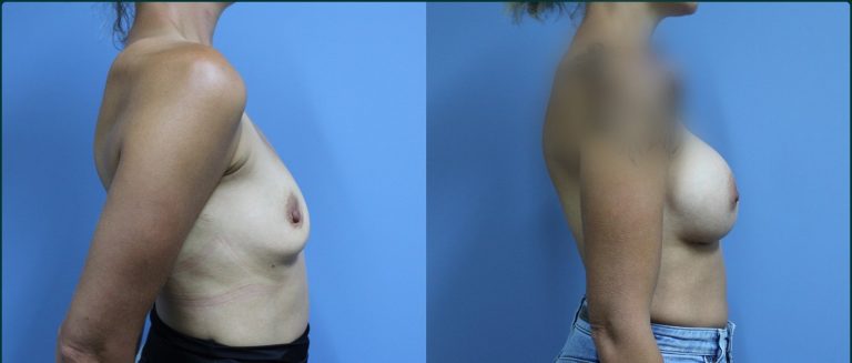 Fat grafting (fat transfer) before and after, 90° right view, female patient, case FAT-L01, Dr Rohit Kumar, Sydney