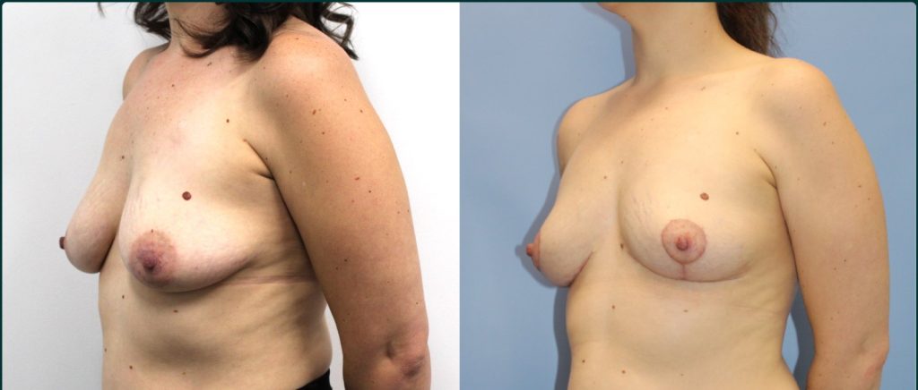 Fat grafting (fat transfer) before and after, 45° left view, female patient, case FAT-L02, Dr Rohit Kumar, Sydney