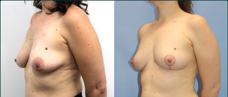 Fat grafting (fat transfer) before and after, 45° left view, female patient, case FAT-L02, Dr Rohit Kumar, Sydney