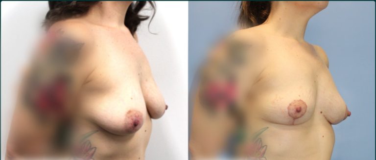 Fat grafting (fat transfer) before and after, 45° right view, female patient, case FAT-L02, Dr Rohit Kumar, Sydney