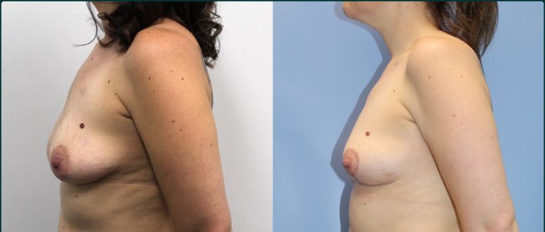 Fat grafting (fat transfer) before and after, 90° left view, female patient, case FAT-L02, Dr Rohit Kumar, Sydney