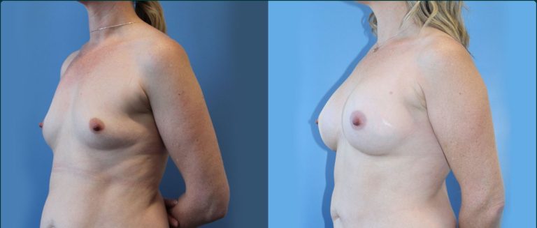 Fat grafting (fat transfer) before and after, 45° left view, female patient, case FAT-L03, Dr Rohit Kumar, Sydney