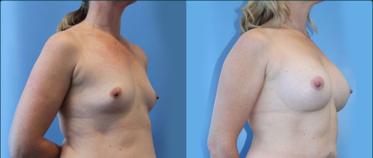Fat grafting (fat transfer) before and after, 45° right view, female patient, case FAT-L03, Dr Rohit Kumar, Sydney