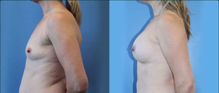 Fat grafting (fat transfer) before and after, 90° left view, female patient, case FAT-L03, Dr Rohit Kumar, Sydney