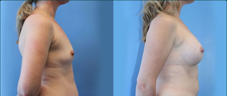 Fat grafting (fat transfer) before and after, 90° right view, female patient, case FAT-L03, Dr Rohit Kumar, Sydney