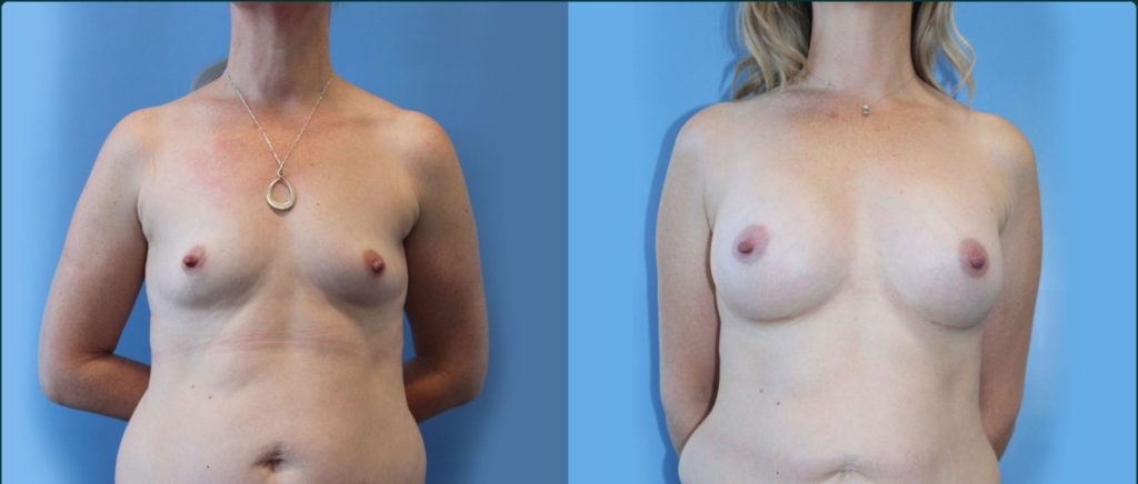 Fat grafting (fat transfer) before and after, front view, female patient, case FAT-L03, Dr Rohit Kumar, Sydney
