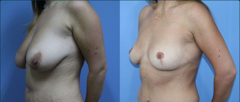Fat grafting (fat transfer) before and after, 45° right view, female patient, case FAT-L04, Dr Rohit Kumar, Sydney