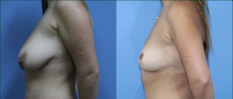Fat grafting (fat transfer) before and after, 90° left view, female patient, case FAT-L04, Dr Rohit Kumar, Sydney