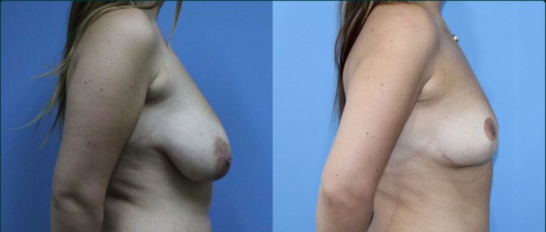 Fat grafting (fat transfer) before and after, 90° right view, female patient, case FAT-L04, Dr Rohit Kumar, Sydney