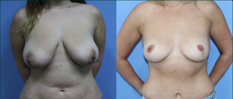 Fat grafting (fat transfer) before and after, front view, female patient, case FAT-L04, Dr Rohit Kumar, Sydney