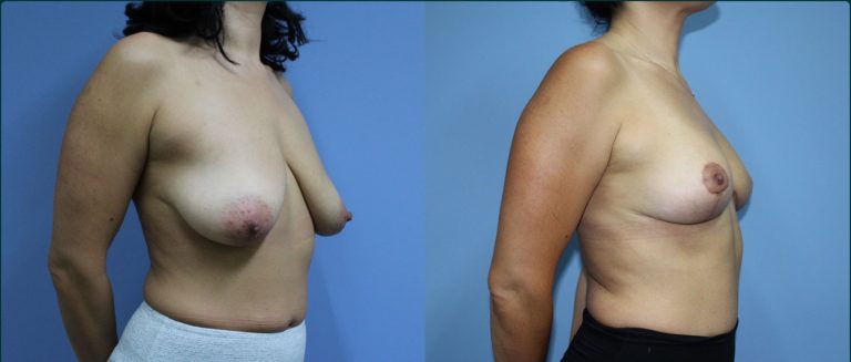 Fat grafting (fat transfer) before and after, 45° left view, female patient, case FAT-L05, Dr Rohit Kumar, Sydney