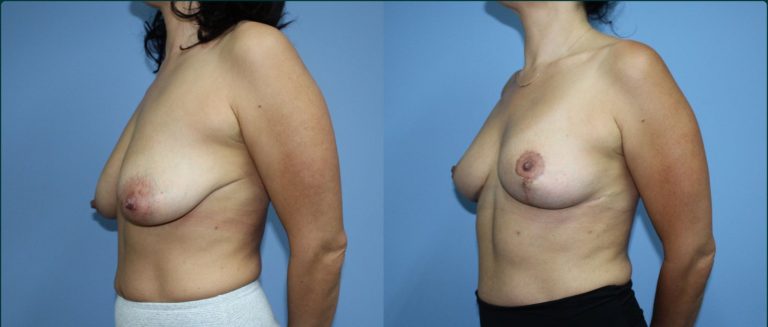 Fat grafting (fat transfer) before and after, 45° right view, female patient, case FAT-L05, Dr Rohit Kumar, Sydney