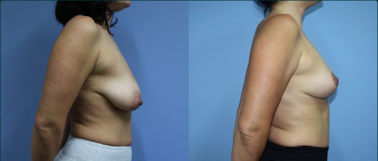 Fat grafting (fat transfer) before and after, 90° left view, female patient, case FAT-L05, Dr Rohit Kumar, Sydney