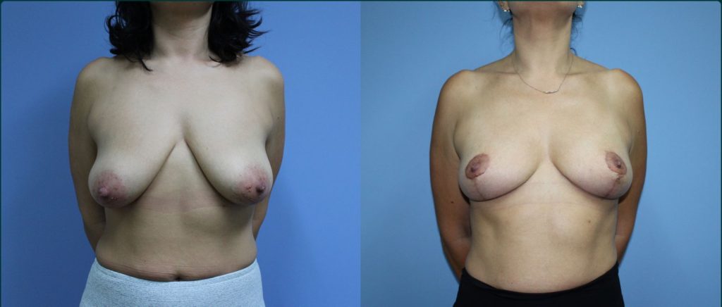 Fat grafting (fat transfer) before and after, front view, female patient, case FAT-L05, Dr Rohit Kumar, Sydney