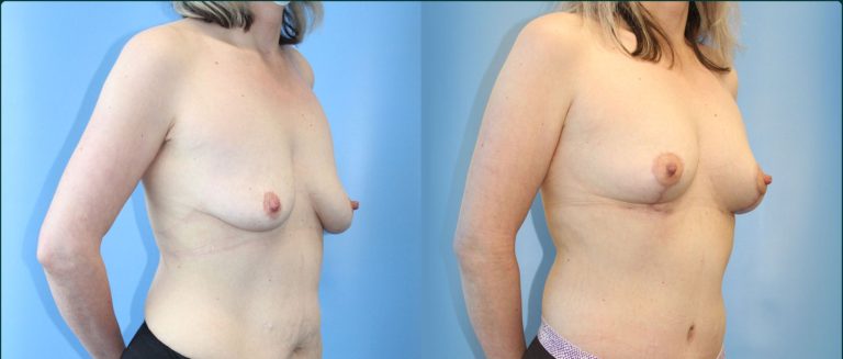 Fat grafting (fat transfer) before and after, 45° left view, female patient, case FAT-L06, Dr Rohit Kumar, Sydney