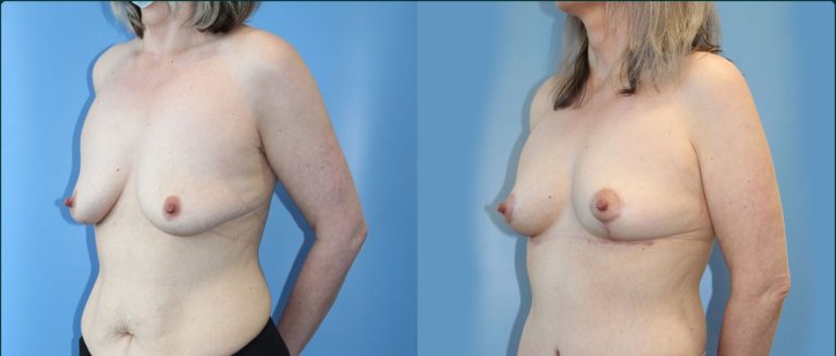 Fat grafting (fat transfer) before and after, 45° right view, female patient, case FAT-L06, Dr Rohit Kumar, Sydney