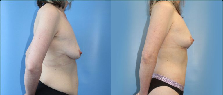 Fat grafting (fat transfer) before and after, 90° left view, female patient, case FAT-L06, Dr Rohit Kumar, Sydney