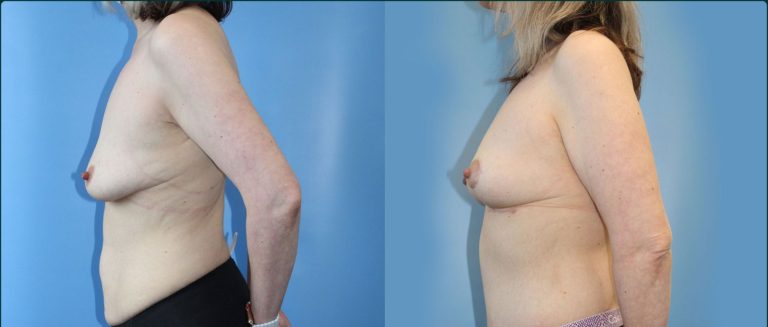 Fat grafting (fat transfer) before and after, 90° right view, female patient, case FAT-L06, Dr Rohit Kumar, Sydney